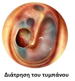 Diatrisi_tympanou2.jpg